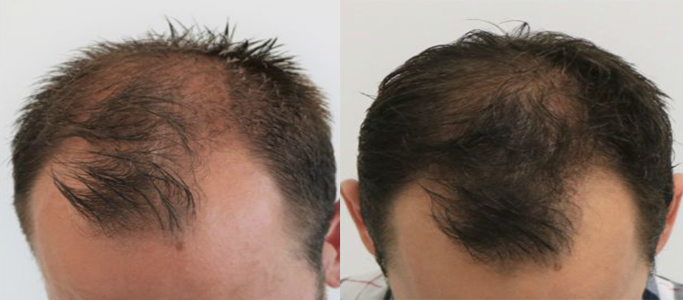 prp cheveux - prp cheveu - prp paris - prp femme cheveux - prp homme cheveux paris