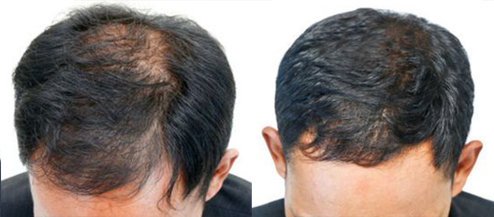 prp cheveux - prp cheveu - prp paris - prp femme cheveux - prp homme cheveux paris
