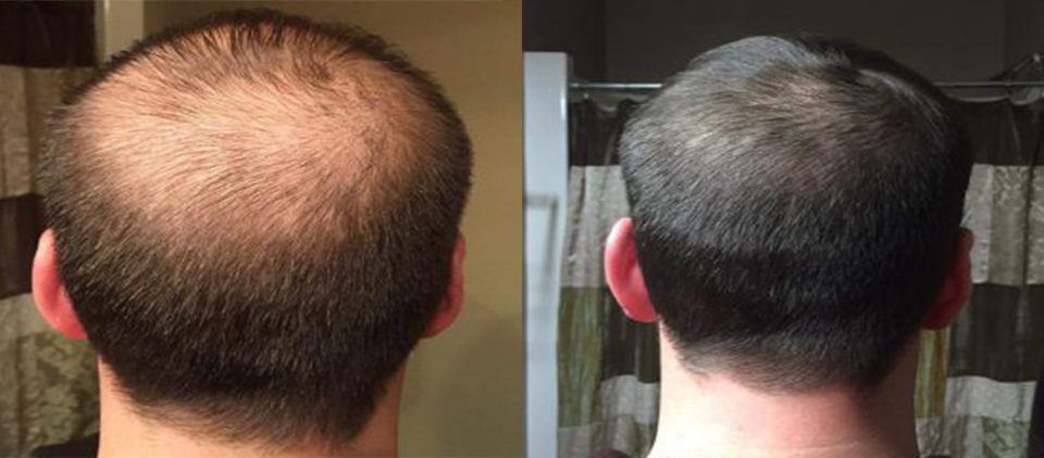 prp cheveux - prp cheveu - prp paris